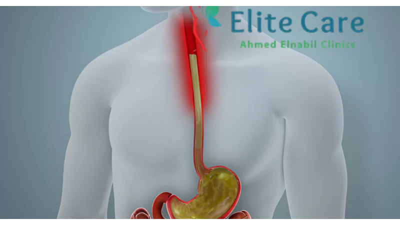 الارتجاع المريئي