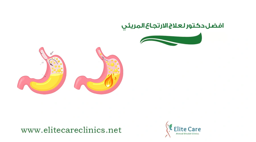 افضل دكتور لعلاج الارتجاع المريئي