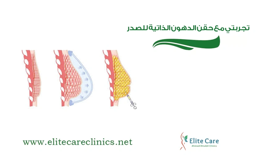 تجربتي مع حقن الدهون الذاتية للصدر