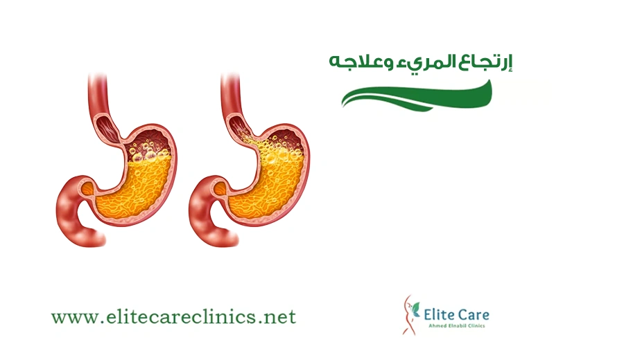 إرتجاع المريء وعلاجه​