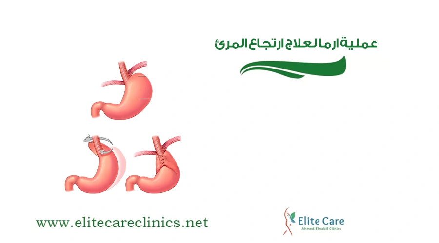عملية ارما لعلاج ارتجاع المرئ