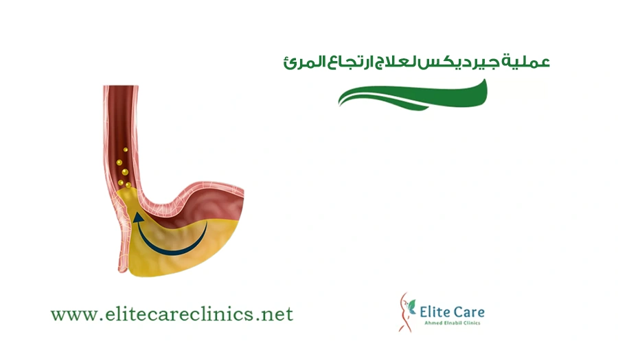 عملية جيرديكس لعلاج ارتجاع المرئ