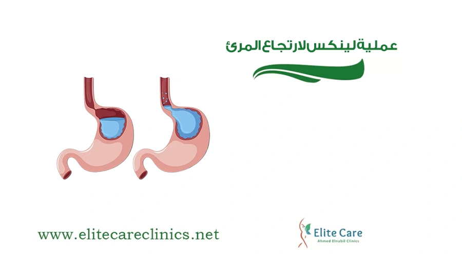 عملية لينكس لارتجاع المرئ