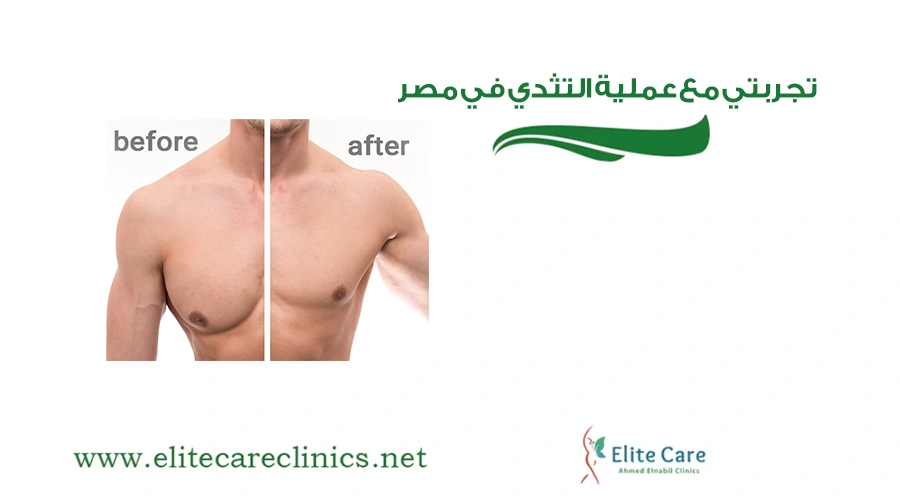 تجربتي مع عملية التثدي في مصر