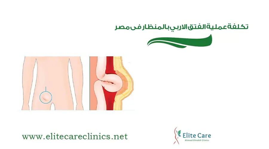 تكلفة عملية الفتق الاربي بالمنظار فى مصر
