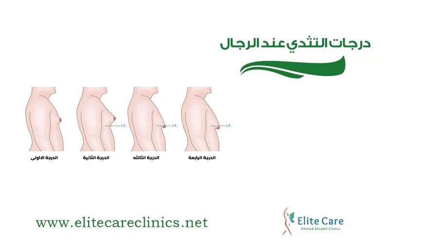 درجات التثدي عند الرجال