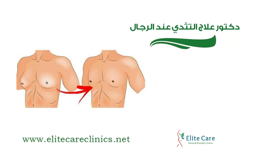 دكتور علاج التثدي عند الرجال
