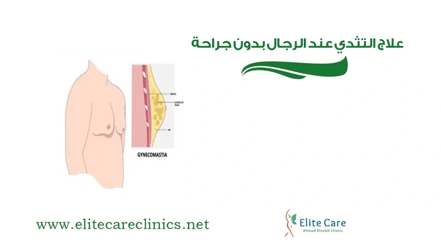 علاج التثدي عند الرجال بدون جراحة