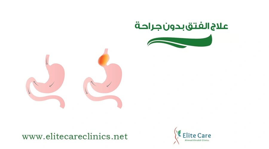 علاج الفتق بدون جراحة