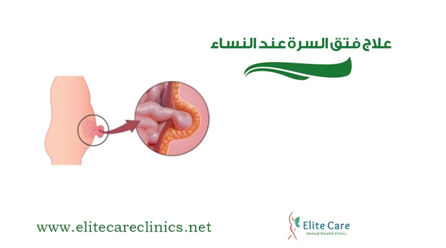 علاج فتق السرة عند النساء