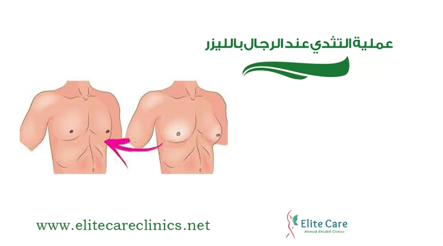 عملية التثدي عند الرجال بالليزر